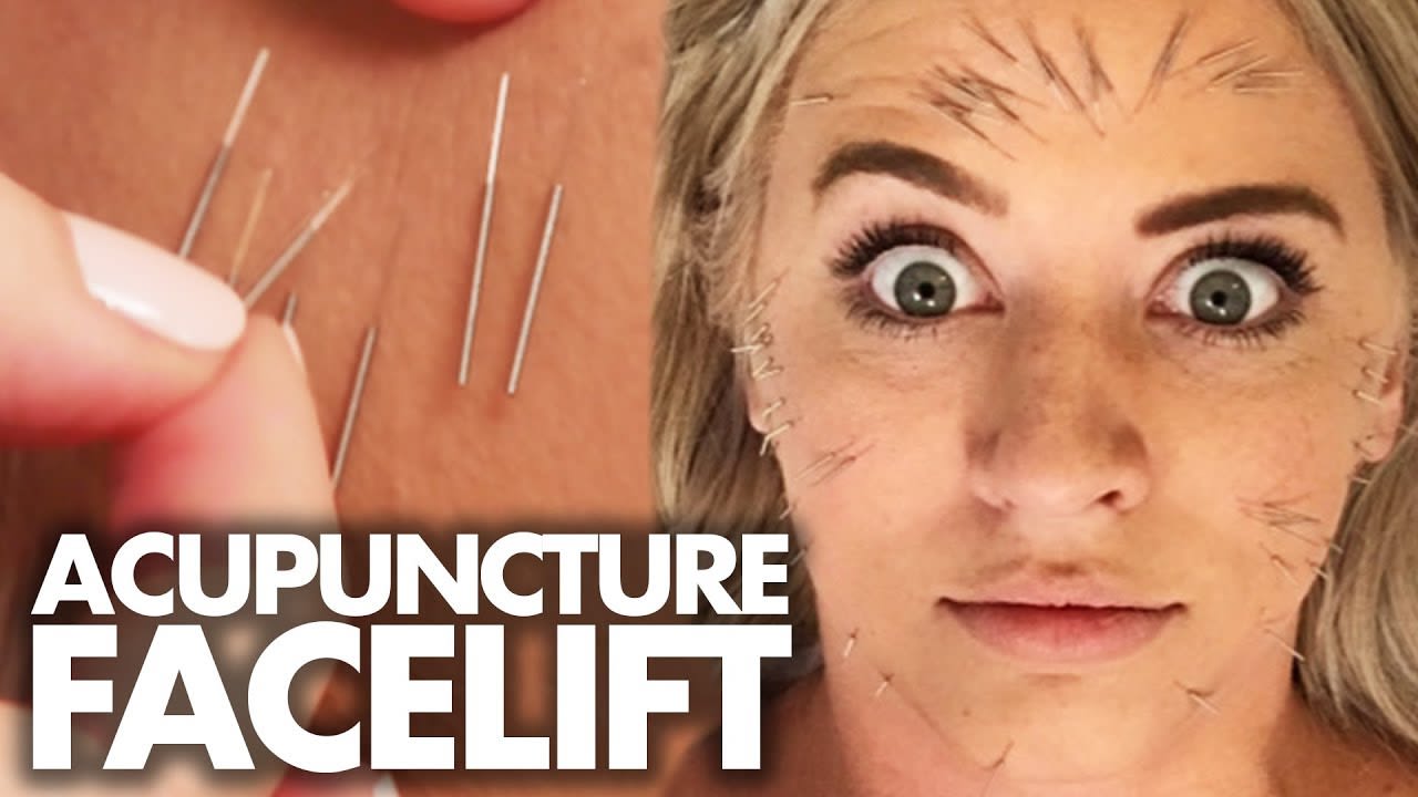 We Got 100 Acupuncture Needles In Our FACE!?! (Beauty Trippin)