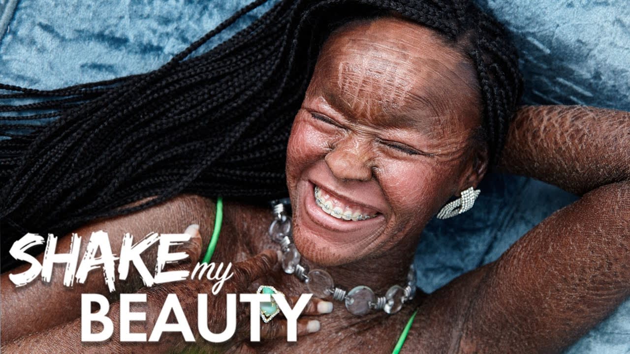 I'm Owning My Skin Condition By Modelling For Glamour | SHAKE MY BEAUTY