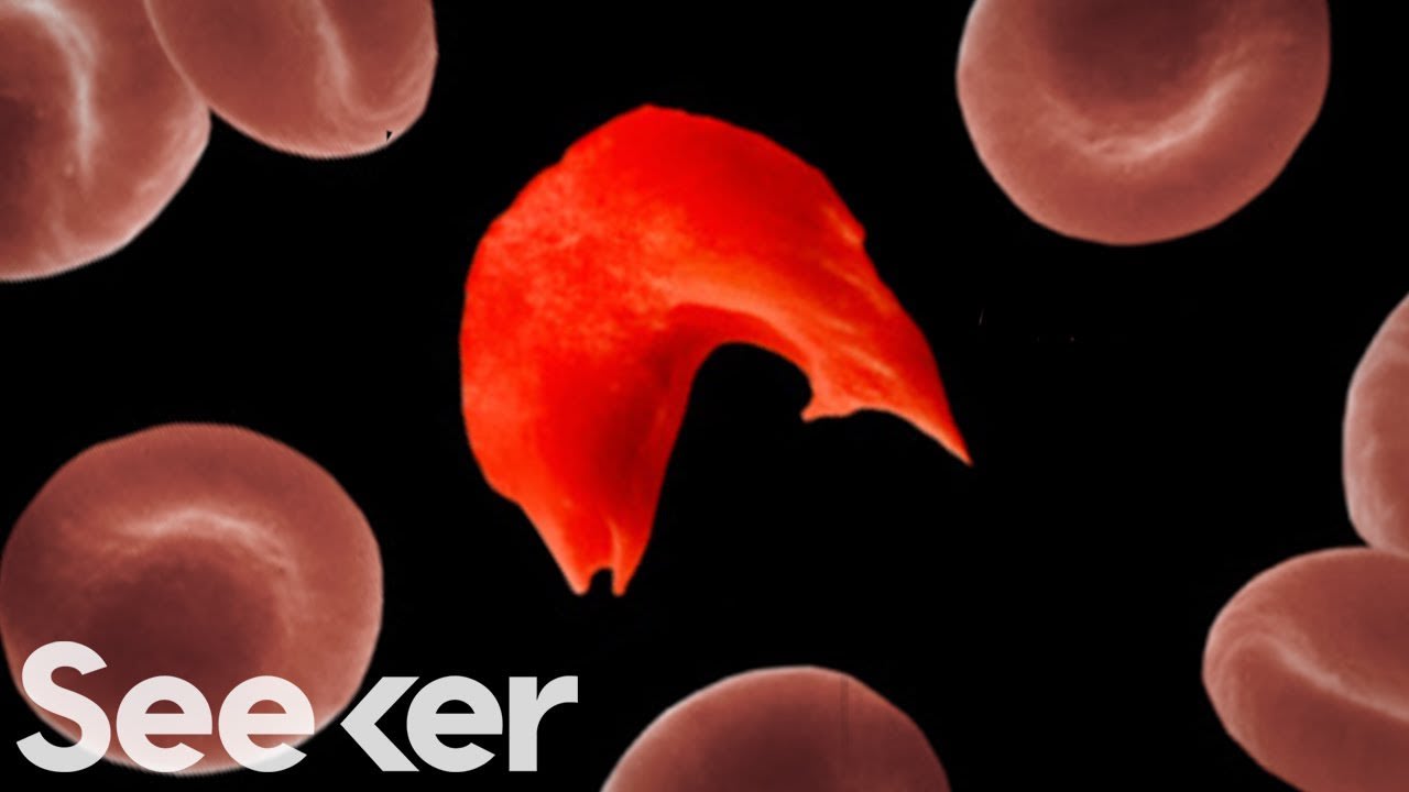What Is Sickle Cell Anemia and How Do You Get It?