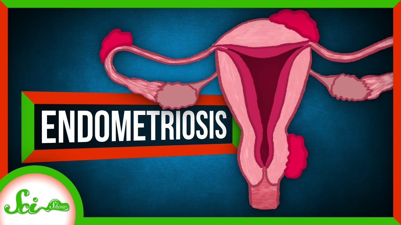 Endometriosis: When Uterine Tissue Goes Rogue