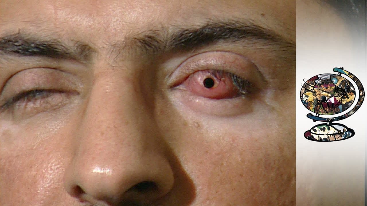 An Eye For A Tooth: Bringing Sight To The Blind (2001)
