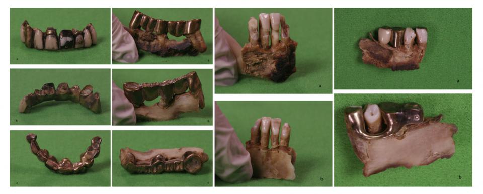 Hitler's Teeth - evidence that had been held by the Russians since Stalin’s forces discovered the charred the remains in Berlin on May 5, 1945. In a paper published in the European Journal of Internal Medicine, the researchers wrote that the teeth certainly belonged to Hitler.