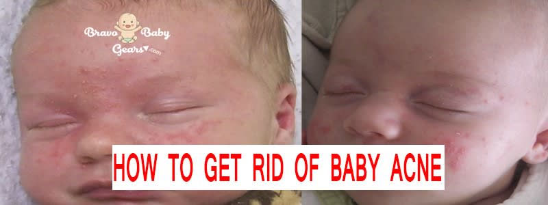 Mix How To Get Rid Of Baby Acne Newborn Baby Acne Treatments