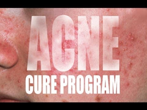 THE ACNE CURE PROGRAM! FAST RESULTS!